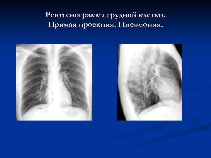 Рентгенограмма грудной клетки. Прямая проекция. Пневмония. 