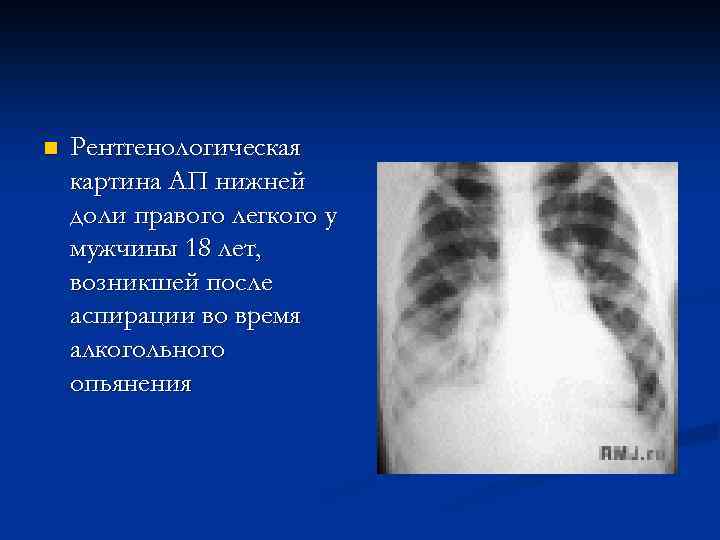 n Рентгенологическая картина АП нижней доли правого легкого у мужчины 18 лет, возникшей после