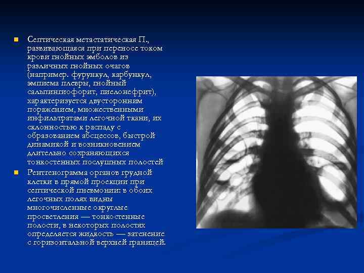 n n Септическая метастатическая П. , развивающаяся при переносе током крови гнойных эмболов из