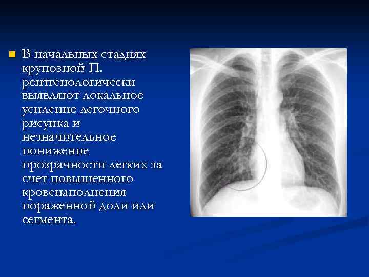 n В начальных стадиях крупозной П. рентгенологически выявляют локальное усиление легочного рисунка и незначительное