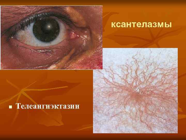 ксантелазмы n Телеангиэктазии 