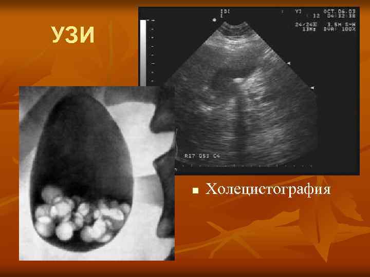 УЗИ n Холецистография 