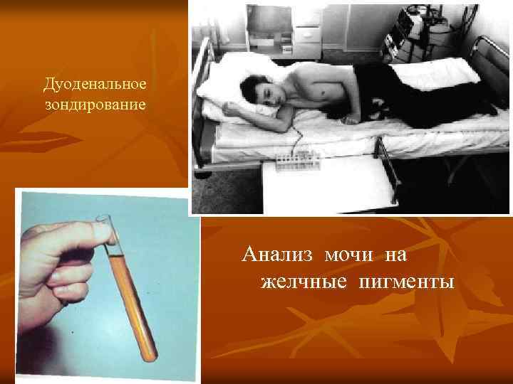 Дуоденальное зондирование Анализ мочи на желчные пигменты 