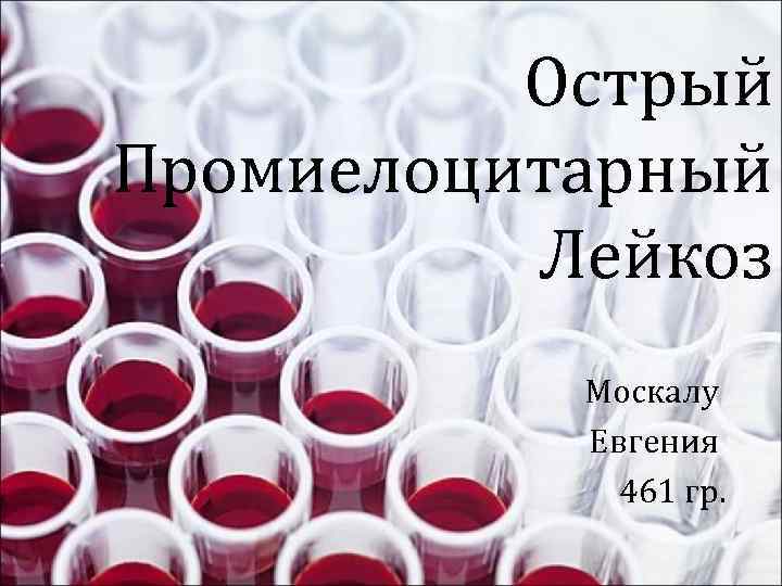 Острый Промиелоцитарный Лейкоз Москалу Евгения 461 гр. 