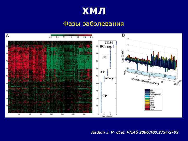 ХМЛ Фазы заболевания Radich J. P. et. al. PNAS 2006; 103: 2794 -2799 