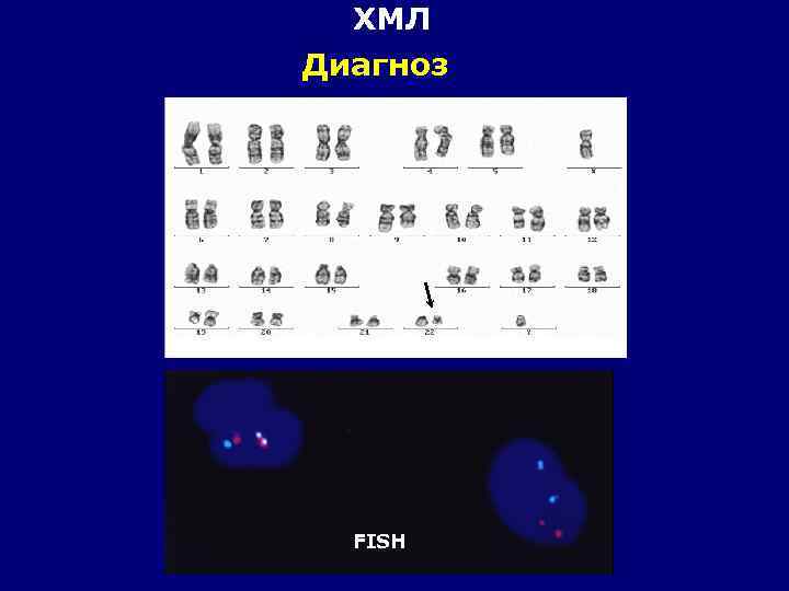 ХМЛ Диагноз FISH 