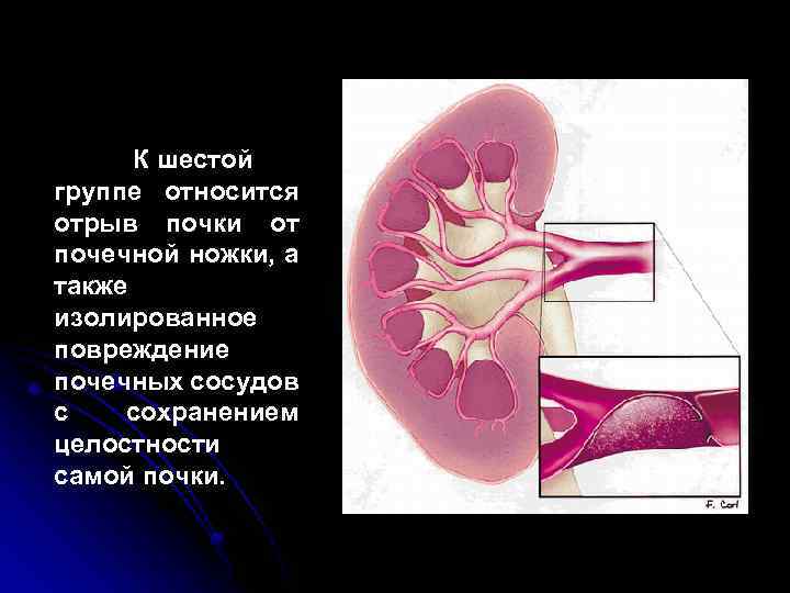 Стенки члс