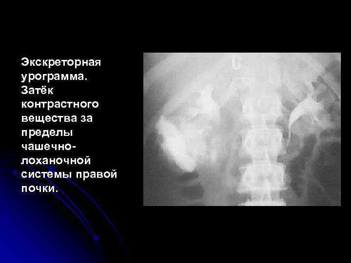 Экскреторная урограмма. Затёк контрастного вещества за пределы чашечнолоханочной системы правой почки. 