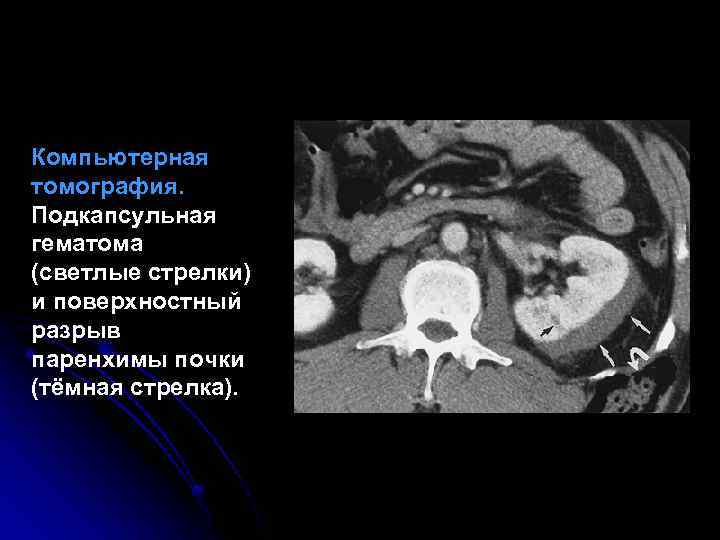 Компьютерная томография. Подкапсульная гематома (светлые стрелки) и поверхностный разрыв паренхимы почки (тёмная стрелка). 