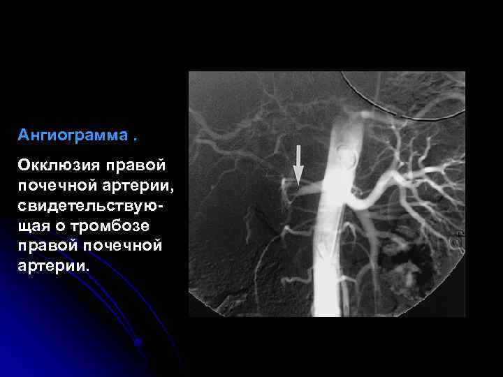 Тромбоз почечной артерии. Ангиография почечных сосудов. Ангиография сосудов почек. Сужение почечной артерии.