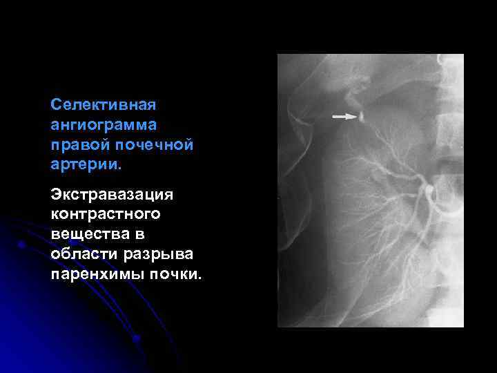 Селективная ангиограмма правой почечной артерии. Экстравазация контрастного вещества в области разрыва паренхимы почки. 