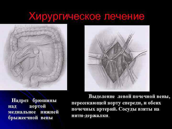 Хирургическое лечение Надрез брюшины над аортой медиальнее нижней брыжеечной вены Выделение левой почечной вены,