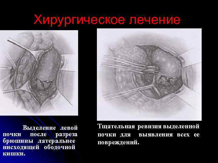 Хирургическое лечение Выделение левой почки после разреза брюшины латеральнее нисходящей ободочной кишки. Тщательная ревизия