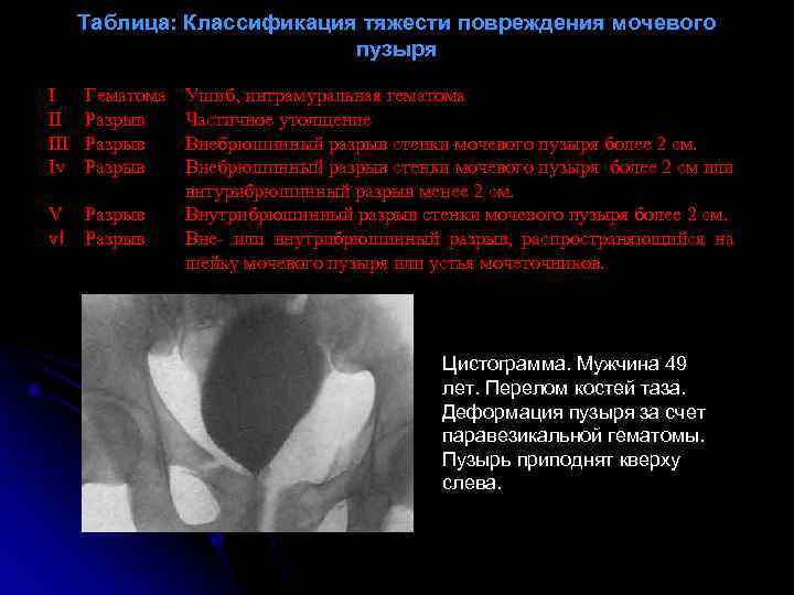 Таблица: Классификация тяжести повреждения мочевого пузыря I II Iv Гематома Разрыв V v. I