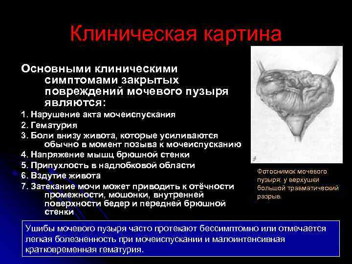 Клиническая картина Основными клиническими симптомами закрытых повреждений мочевого пузыря являются: 1. Нарушение акта мочеиспускания