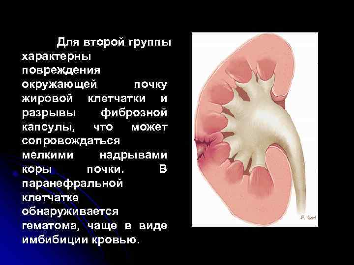 Для второй группы характерны повреждения окружающей почку жировой клетчатки и разрывы фиброзной капсулы, что