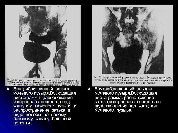 l Внутрибрюшинный разрыв мочевого пузыря. Восходящая цистограмма: расположение контрасного вещества над контуром мочевого пузыря