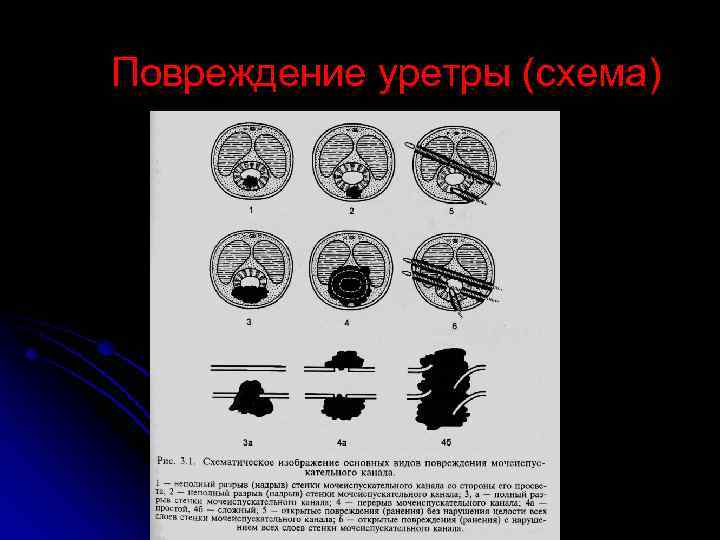 Повреждение уретры (схема) 