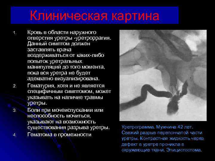 Клиническая картина 1. 2. 3. 4. Кровь в области наружного отверстия уретры -уретроррагия. Данный