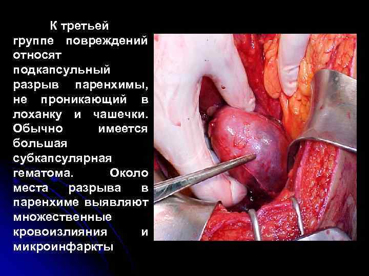 К третьей группе повреждений относят подкапсульный разрыв паренхимы, не проникающий в лоханку и чашечки.