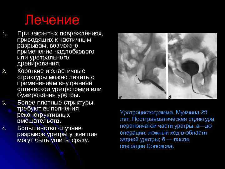 Лечение 1. 2. 3. 4. При закрытых повреждениях, приводящих к частичным разрывам, возможно применение