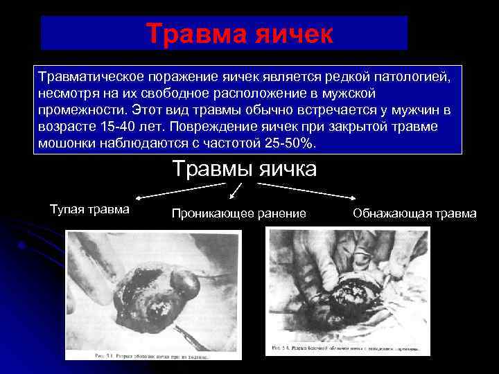 Травма яичек Травматическое поражение яичек является редкой патологией, несмотря на их свободное расположение в