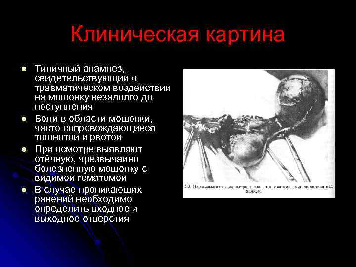 Клиническая картина l l Типичный анамнез, свидетельствующий о травматическом воздействии на мошонку незадолго до