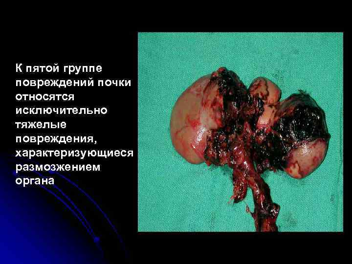 К пятой группе повреждений почки относятся исключительно тяжелые повреждения, характеризующиеся размозжением органа 