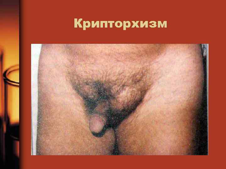 Крипторхизм • Паховые яички 