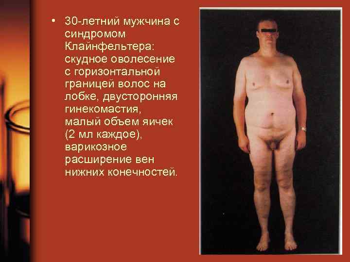  • 30 летний мужчина с синдромом Клайнфельтера: скудное оволесение с горизонтальной границей волос