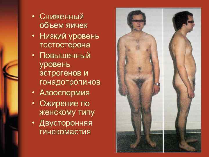  • Сниженный объем яичек • Низкий уровень тестостерона • Повышенный уровень эстрогенов и