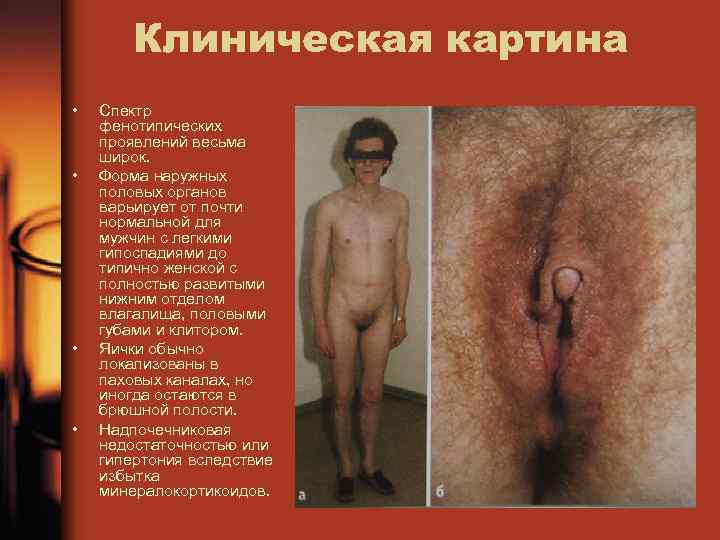 Клиническая картина • • Спектр фенотипических проявлений весьма широк. Форма наружных половых органов варьирует