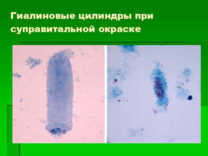 Гиалиновые цилиндры при суправитальной окраске 