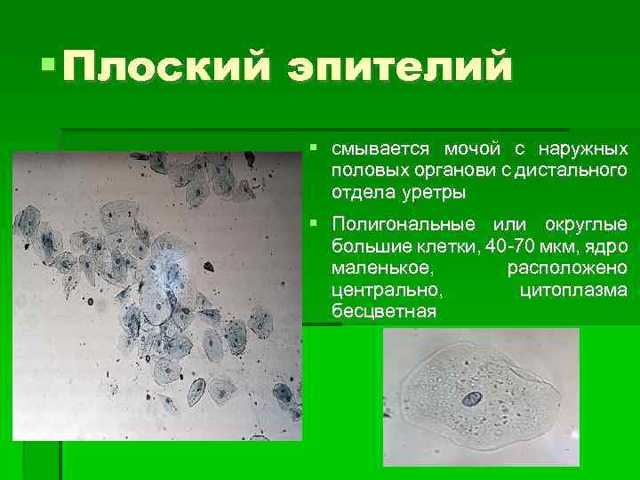  Плоский эпителий смывается мочой с наружных половых органови с дистального отдела уретры Полигональные