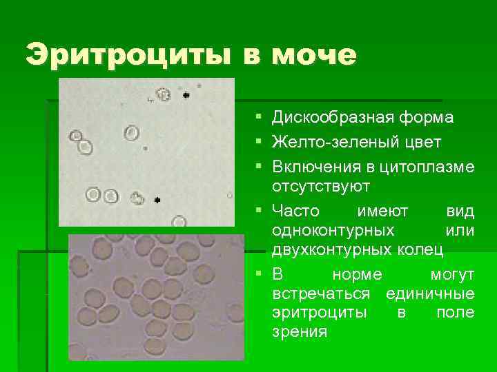 Эритроциты в моче Дискообразная форма Желто-зеленый цвет Включения в цитоплазме отсутствуют Часто имеют вид