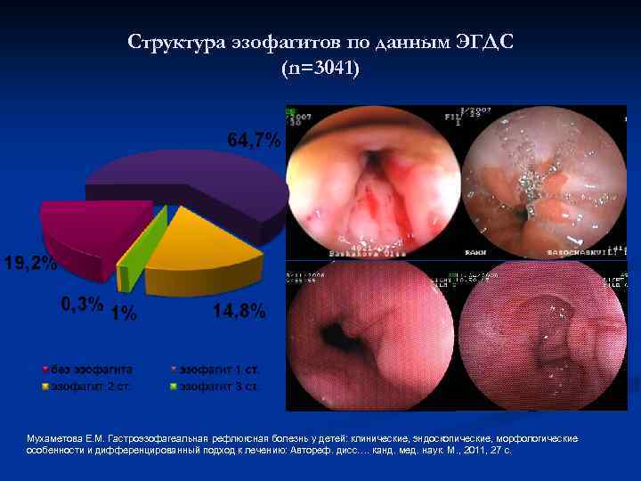 Структура эзофагитов по данным ЭГДС (n=3041) Мухаметова Е. М. Гастроэзофагеальная рефлюксная болезнь у детей: