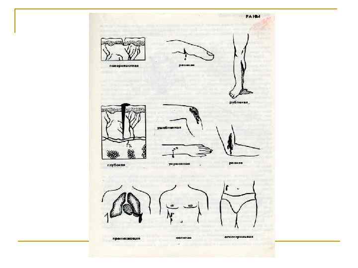 Помощь при ожогах: n n n Вынести пострадавшего из зоны действия источника высокой температуры