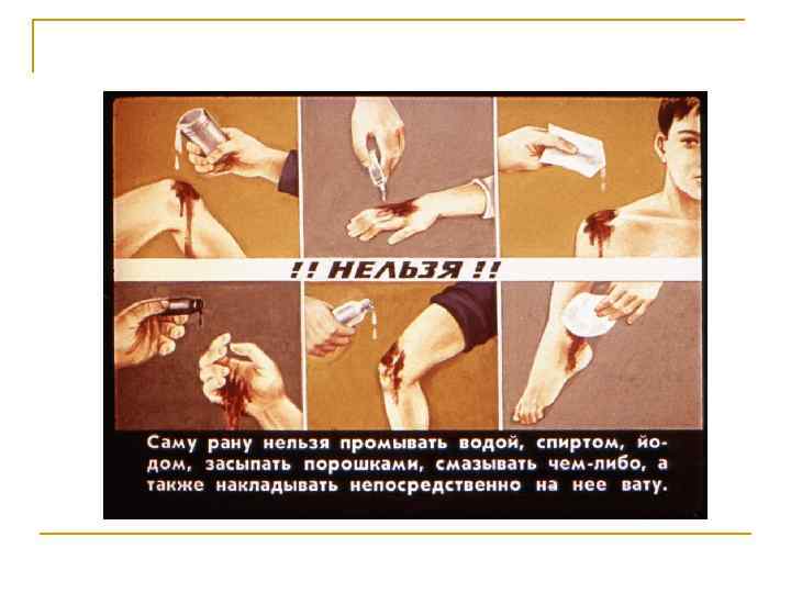 n n n n n Степени отморожения: 1 степень побледнение кожи, потеря чувствительности 2