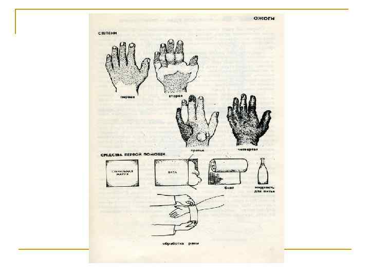 Переломы. Первая помощь. n n Перелом – это нарушение целости костей. Кость хоть и