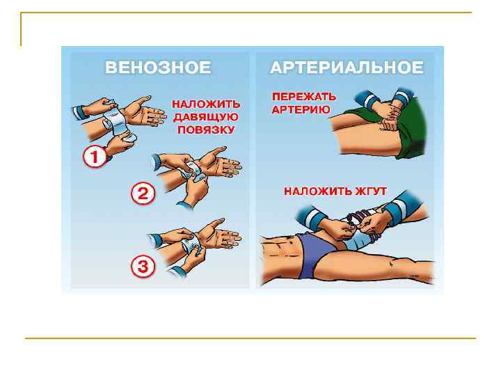 Помощь при артериальном кровотечении 
