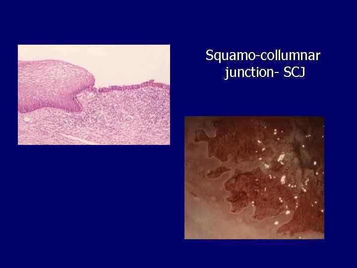 Squamo-collumnar junction- SCJ 