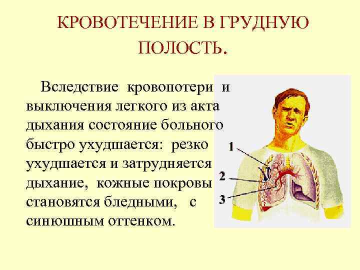 Кровотечение в полость. Кровотечение в грудную полость. Кровоизлияние в грудную полость. Внутреннее кровотечение в грудную полость. Внутреннее кровотечение груди.