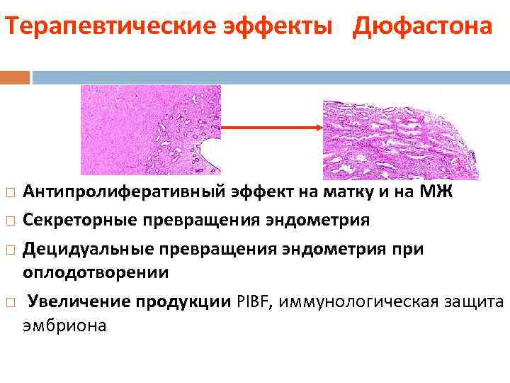 Терапевтические эффекты Дюфастона Антипролиферативный эффект на матку и на МЖ Секреторные превращения эндометрия Децидуальные