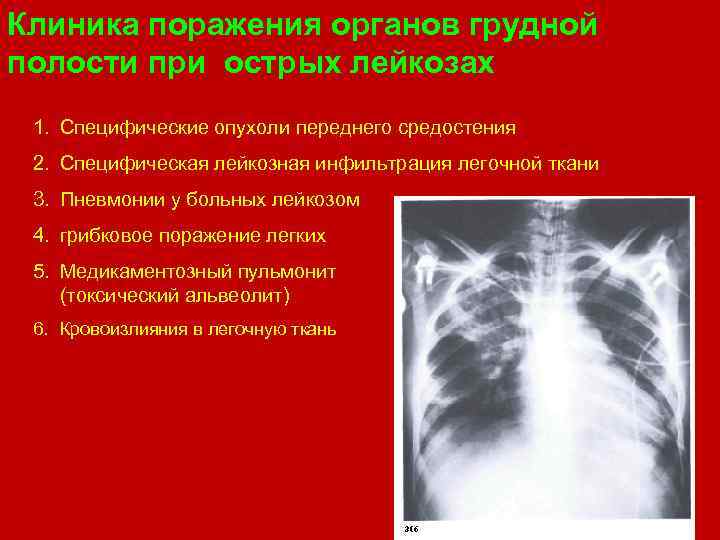 Клиника поражения органов грудной полости при острых лейкозах 1. Специфические опухоли переднего средостения 2.