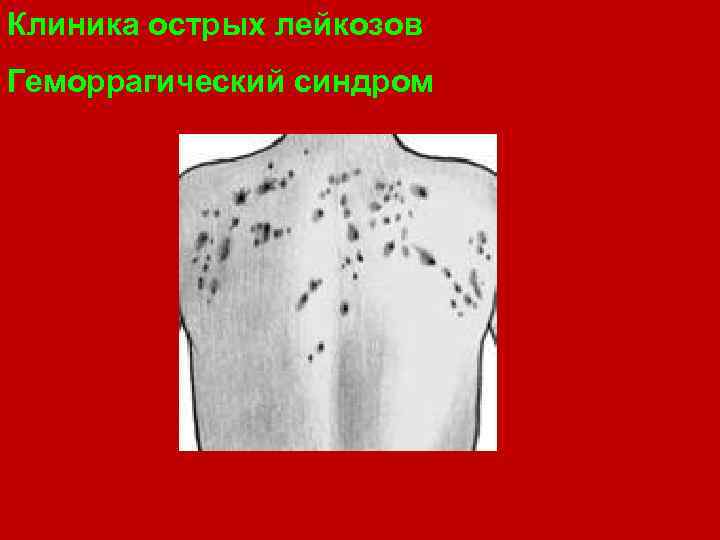 Клиника острых лейкозов Геморрагический синдром 