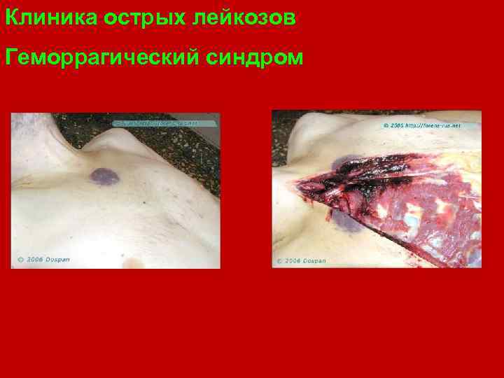 Клиника острых лейкозов Геморрагический синдром 