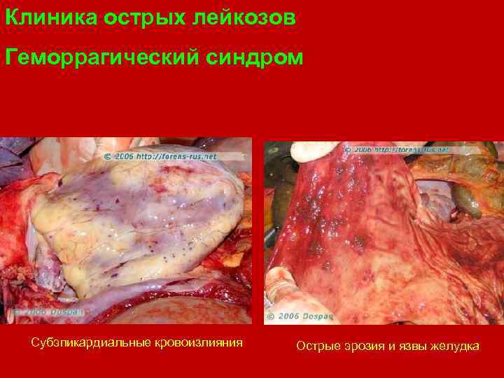 Клиника острых лейкозов Геморрагический синдром Субэпикардиальные кровоизлияния Острые эрозия и язвы желудка 