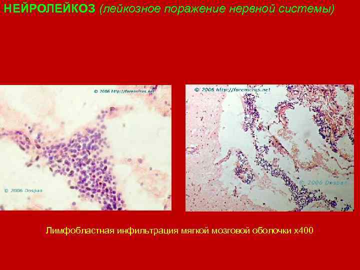 НЕЙРОЛЕЙКОЗ (лейкозное поражение нервной системы) Лимфобластная инфильтрация мягкой мозговой оболочки х400 