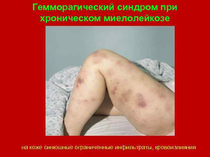 Гемморагический синдром при хроническом миелолейкозе на коже синюшные ограниченные инфильтраты, кровоизлияния 