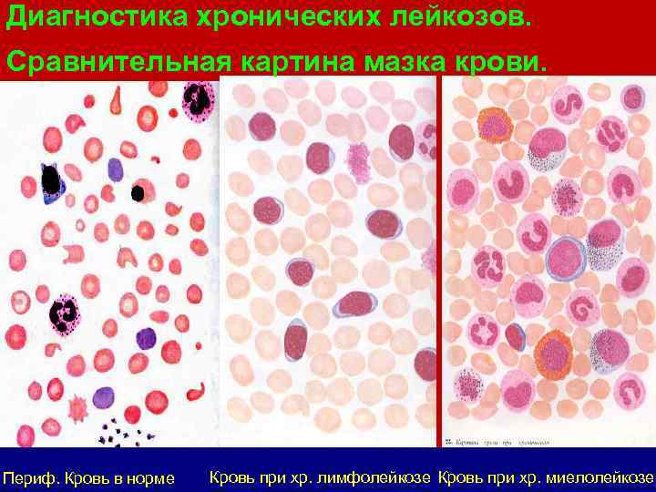 Диагностика хронических лейкозов. Сравнительная картина мазка крови. Периф. Кровь в норме Кровь при хр.